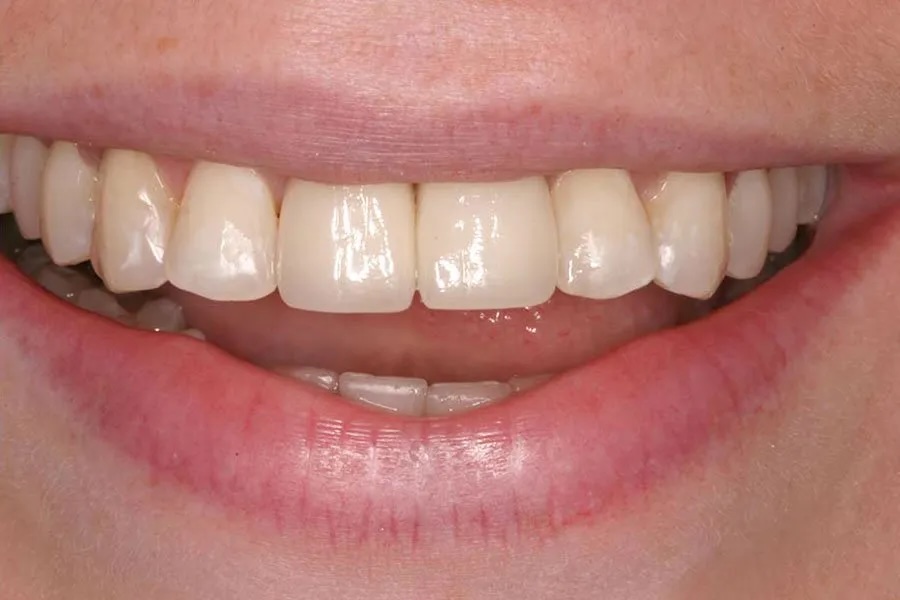 Implant-supported after