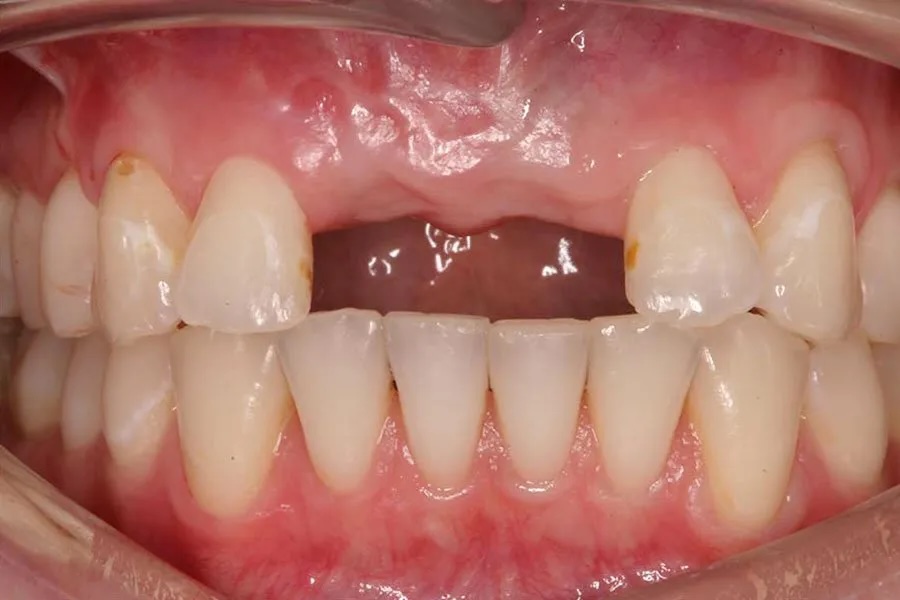 Implant-supported before