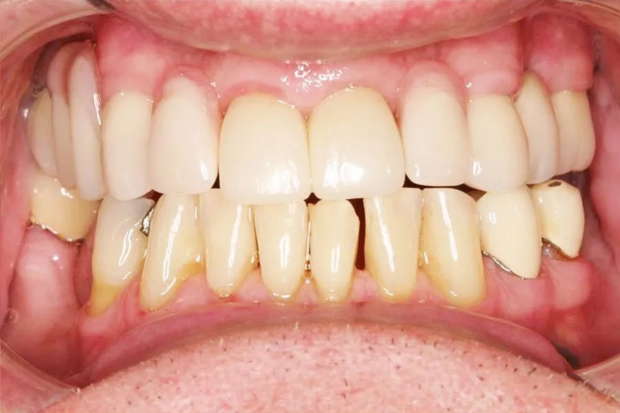 Partial dentures after