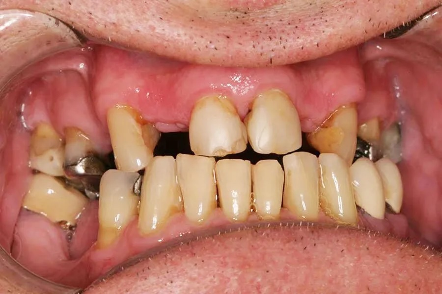 Partial dentures before