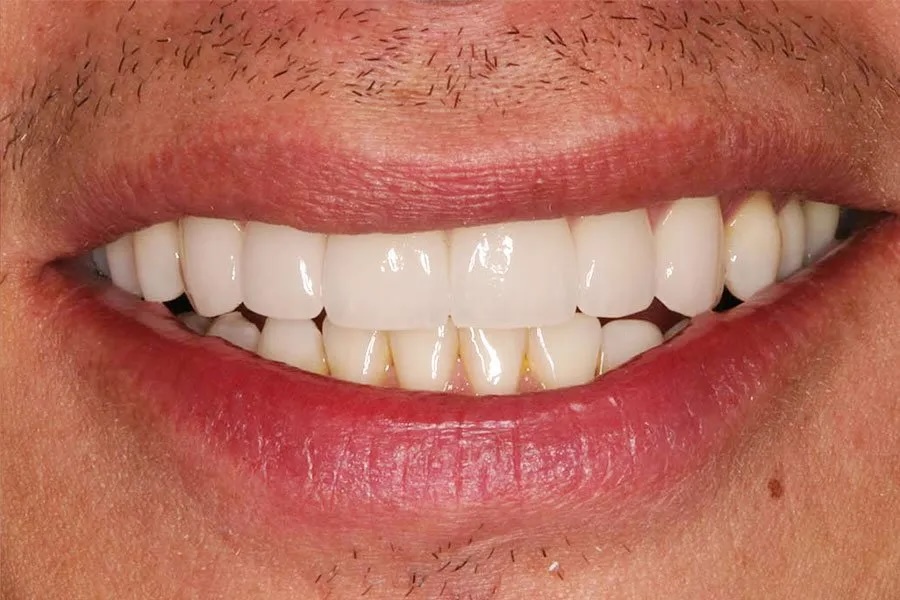 Veneers after