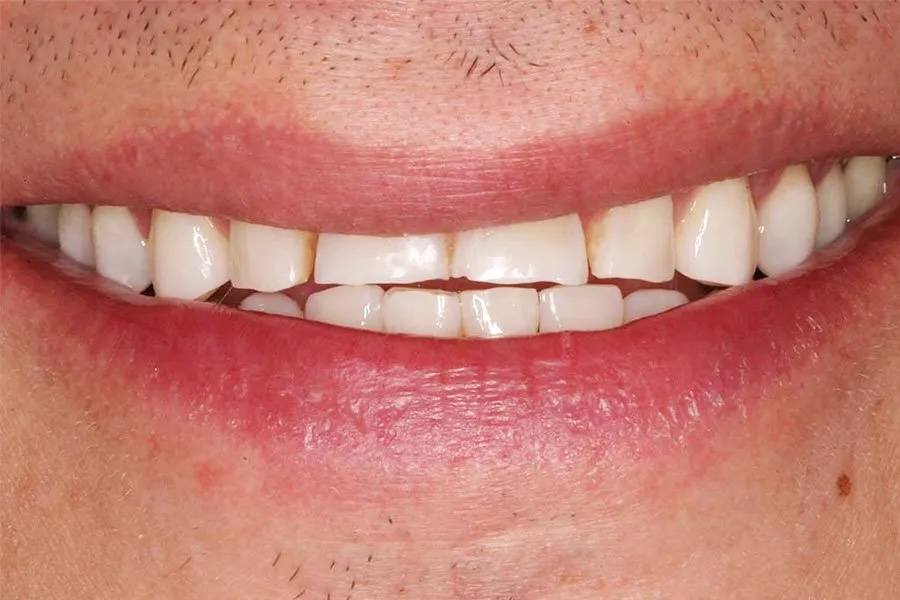 Veneers before