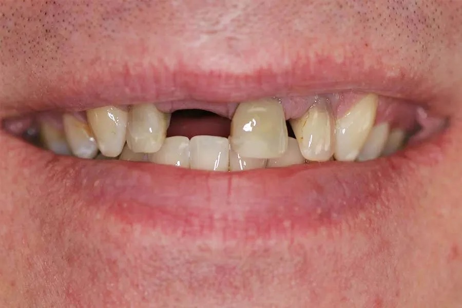 Bridge before