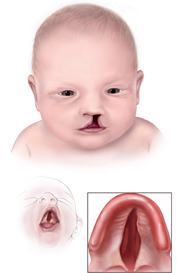 Cleft palate