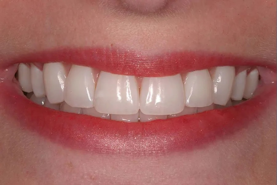 Whitening after