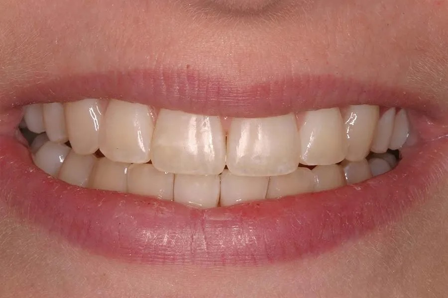 Whitening before