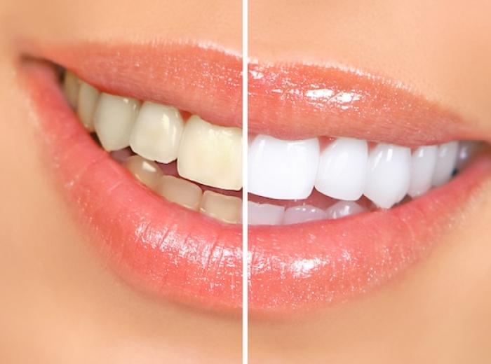 Teeth Whitening – Ever Wonder How It Works?
